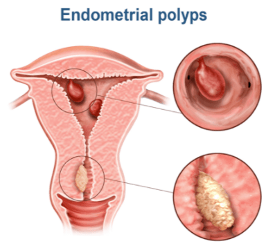 Endometrial Polyp