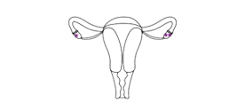 Ovarian Cysts treatment