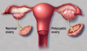 Polycystic Ovarian Syndrome Treatment
