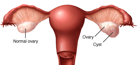 Ovarian Cyst | Dr Tamara Hunter | Specialist Gynaecologist ...
