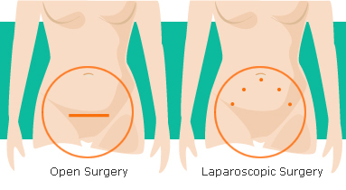 gynaecological surgery