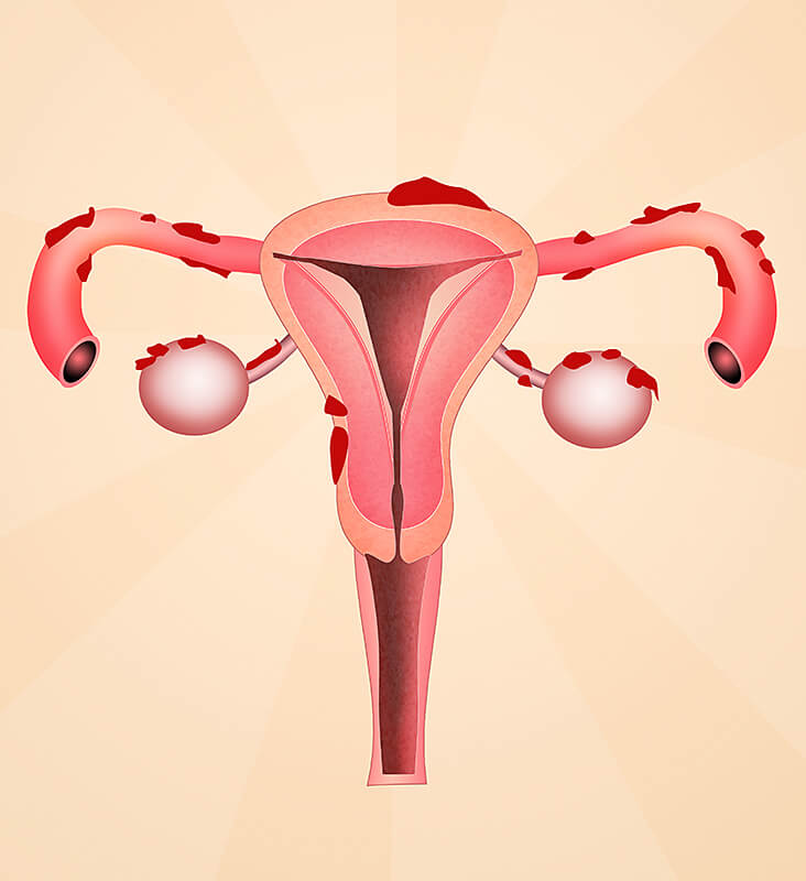 Endometriosis and ivf | IVF specialist Perth WA Tamara Hunter